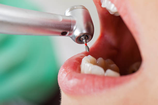 Best Emergency Dentist for Knocked-Out Tooth in Old Greenwich, CT